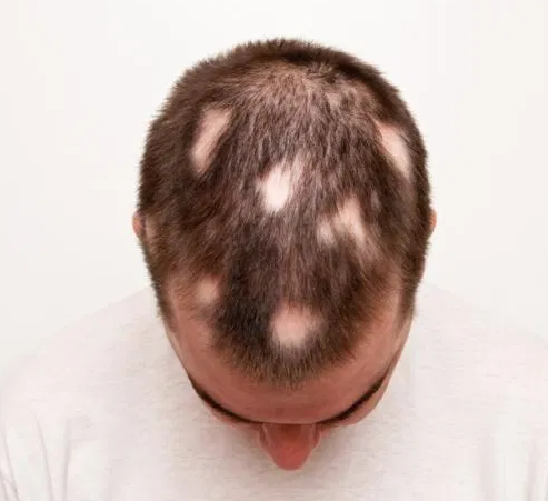 Hair Loss in young mans scalp